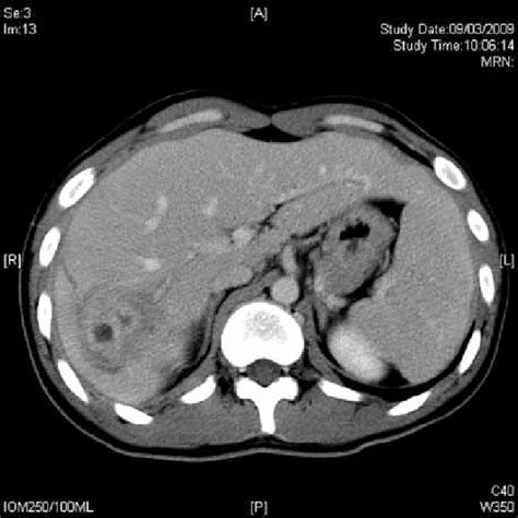 Computed Tomographic Image Showing A Rim Enhancing Lesion Suggestive Of