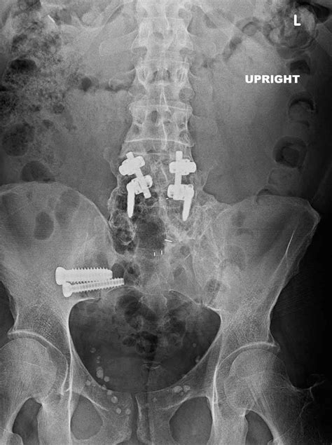 Sacroiliac Joint Fusion Spine Surgeon Vail Aspen