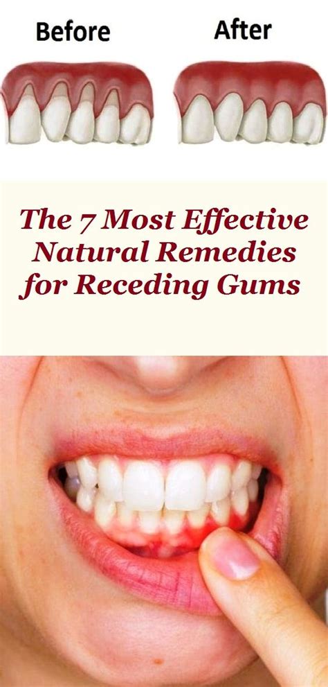 The 7 Most Effective Natural Remedies For Receding Gums Receding Gums