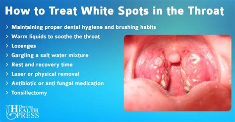 White Spots On Throat Common Causes Images Included Images And