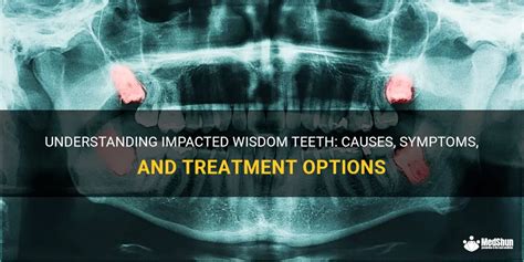 Understanding Impacted Wisdom Teeth Causes Symptoms And Treatment