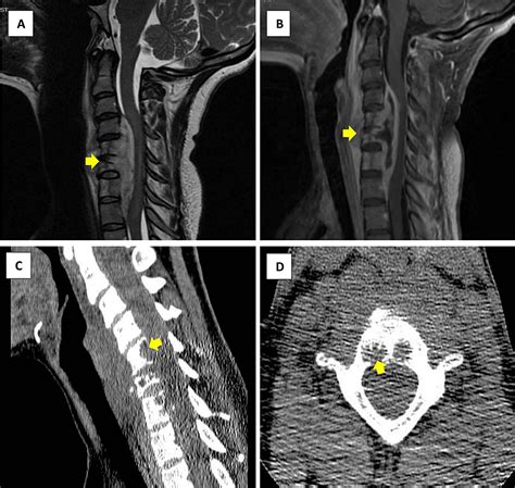 Cureus Isolated Tuberculosis Of The Cervical Vertebrae