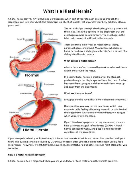 Hiatal Hernia Info And Resources