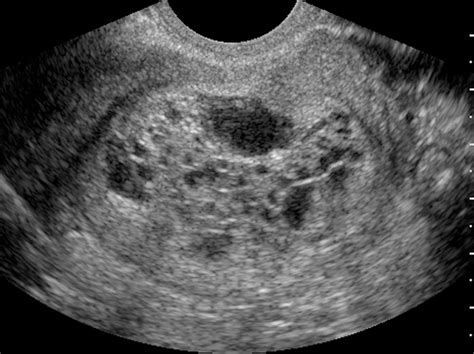 Hydatidiform Mole Molar Pregnancy Pregnancy Molar