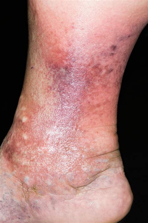 Cellulitis Of The Leg Photograph By Dr P Marazziscience Photo Library
