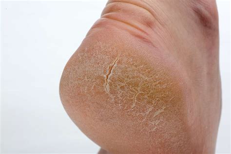 What Causes Cracked Heels Top 5 Facts Icy Health