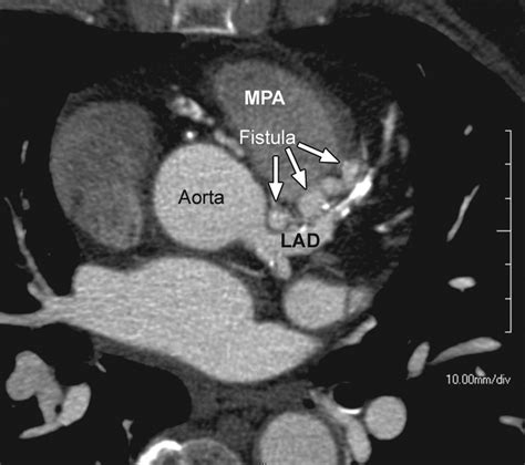 Coronary Artery Fistulas Ct Findings Radiographics