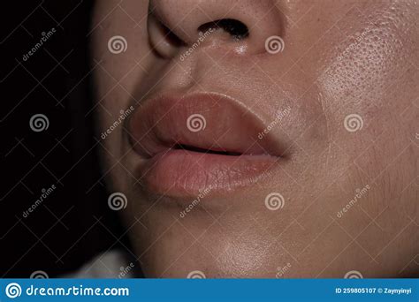 Swollen Or Thickened Upper Lip Of Asian Man Angioedema Causes May Be