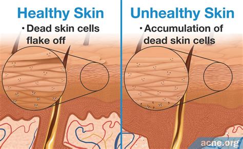What Are The Most Common Causes Of Dead Skin Cells Heidi Salon