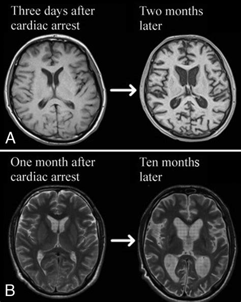 Anoxic Brain Injury Ct Scan Ct Scan Machine