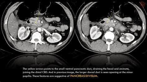 Ultimate Radiology Acute Pancreatitis With Hemorrhage And Pancreas