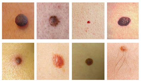 Ways To Get Rid Of Moles At Home Moles Warts And Skin Tags Removal