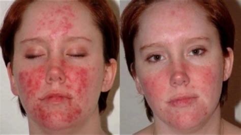 Before And After Cystic Acne Stephanies Journey Youtube