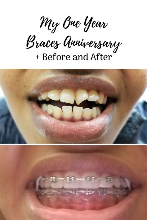 Teeth Braces To Lose Weight Braces Post