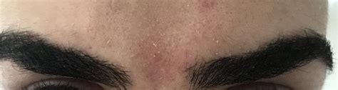 Dandruffdry Skin On Eyebrows What Can I Do About This Dandruff