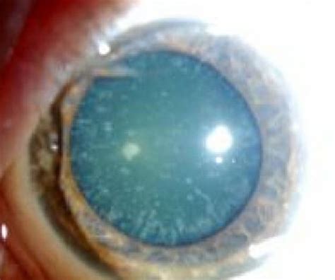 Clinical Photograph Of A Cerulean Cataract In A Patient With Down