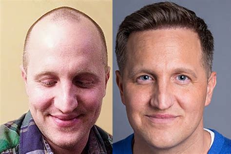 Hair Transplant Beforeafter Results For Men Bosley Hair Transplant