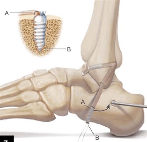 Schematic Representation Of The Lateral Ligament Download