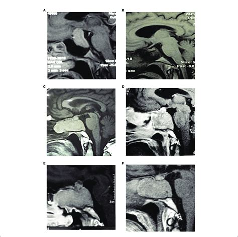 mri images a 2008 preoperative pituitary mri with gadolinium download scientific diagram