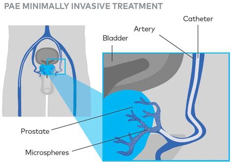 Prostate Artery Embolization PAE Treatment For BPH Varian Patient Portal