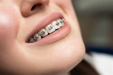 What To Expect During Your Orthodontic Braces Journey Canadiansfcom