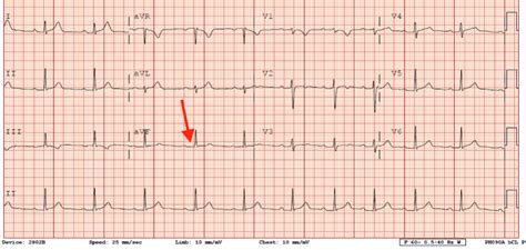 Svt slow presents the great moose migration. Cureus | Antidromic Atrioventricular Reentry Tachycardia ...