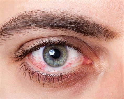 Visual Symptoms Of Eye Problems Heffingtons