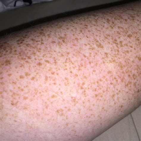 Das kann unterschiedliche ursachen haben. Haut hat eine komische Färbung? (Hand, Flecken, Arm)
