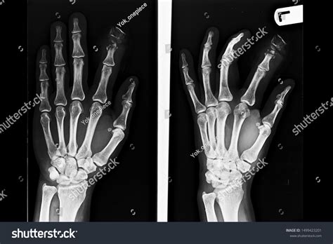 Anteroposterior Oblique View Hand Wrist Xray Stock Photo 1499423201