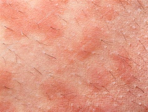 Dermatitis Atópica Por Eccema — Foto De Stock © Antoniogravante 67251371