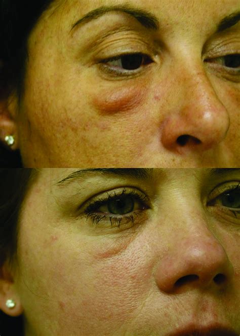 Avoiding Malar Edema During Midfacecheek Augmentation With Dermal