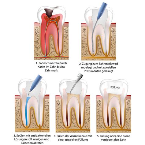 Die natürliche zahnkrone (lateinisch corona dentis) ist der teil eines zahnes, der aus dem zahnfleisch herausragt und mit zahnschmelz bedeckt ist, der härtesten im menschlichen körper vorkommenden substanz. Zahnarztpraxis Neuental - Zahnärztin Susanne ...