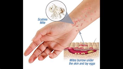 Scabies Causes Symptoms And Treatment Youtube