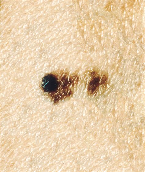People With More Than 11 Moles On Right Arm Prone To Skin Cancer