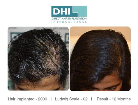 If you are like one of the 80 million american men and women experiencing hair loss, they understand how losing your hair can affect the way you think and feel about yourself, … Female Hair Transplant Results - DHI | Hair loss Forum ...