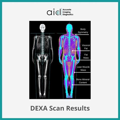 Dexa Body Composition Scan Dexa At Accurate Imaging Diagnostics