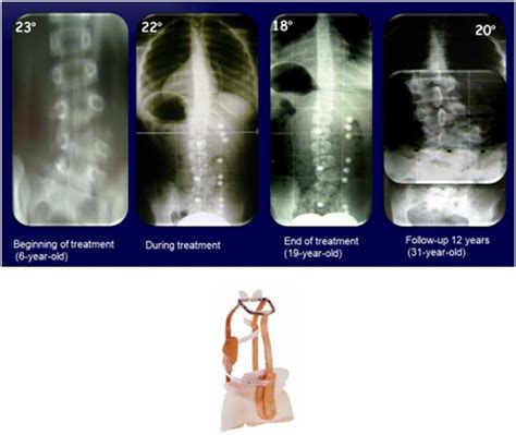Frontiers The Conservative Treatment Of Congenital Scoliosis With