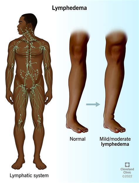 Lymphedema Symptoms Causes Treatment