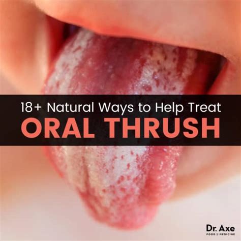 Oral Thrush Natural Treatments To Relieve It Dr Axe