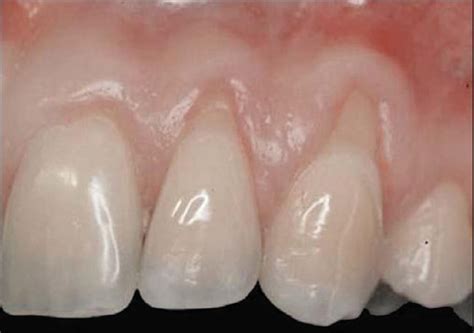 Class Ii Gingival Recession On The Left Maxillary Canine And Lateral