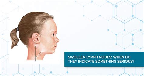 Swollen Lymph Nodes Kids