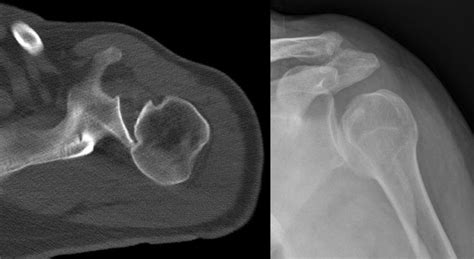 Posterior Shoulder Dislocation With Inverse Hill Sachs Lesion