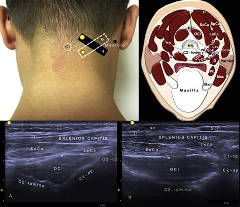 Sonographic Guide For Botulinum Toxin Injections Of The Neck Muscles In