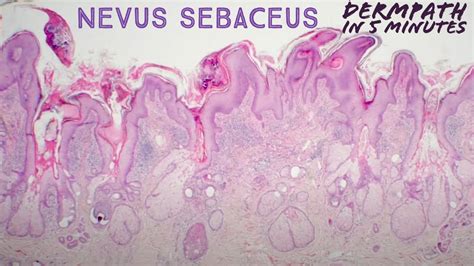 Nevus Sebaceus Dermpath In 5 Minutes Pathology Dermatology