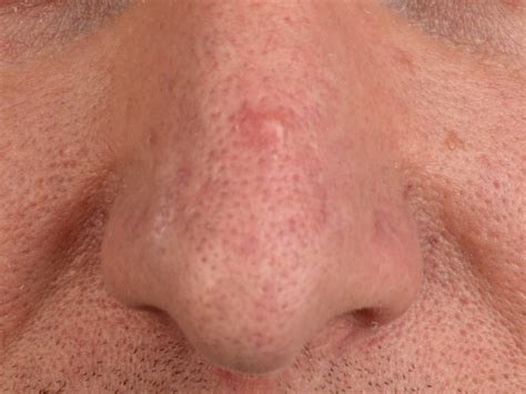 Fibrous Papule Of The Face Or Nose