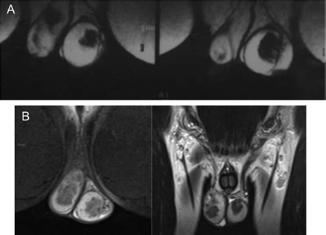 Testicular MRI In Patients With TART A Patient During The Download Scientific Diagram