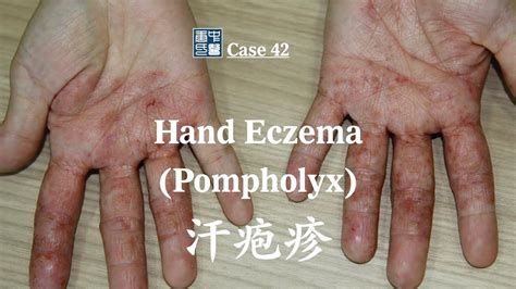 Hand Eczema Pompholyx 手湿疹 汗疱疹 Youtube