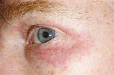 Rash Around Eyes Learn About Symptoms And Possible Causes
