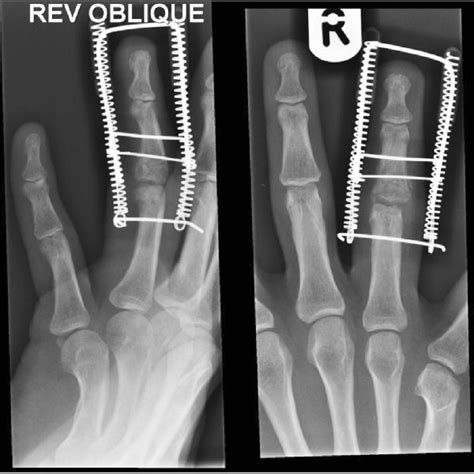 Case Presentation Post Operative Radiographic Views Of Ligamentotaxor