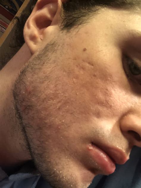 Is There Any Safe Treatment For Acne Scars While Being On Accutane Human